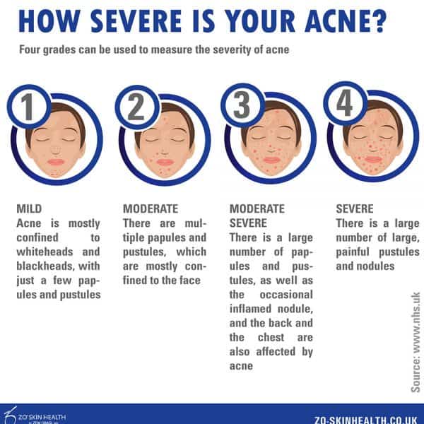 Diagram or chart showing the different levels of acne