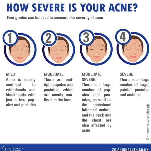 Let s Talk Skin Acne Blackheads Blog Vie Aesthetics