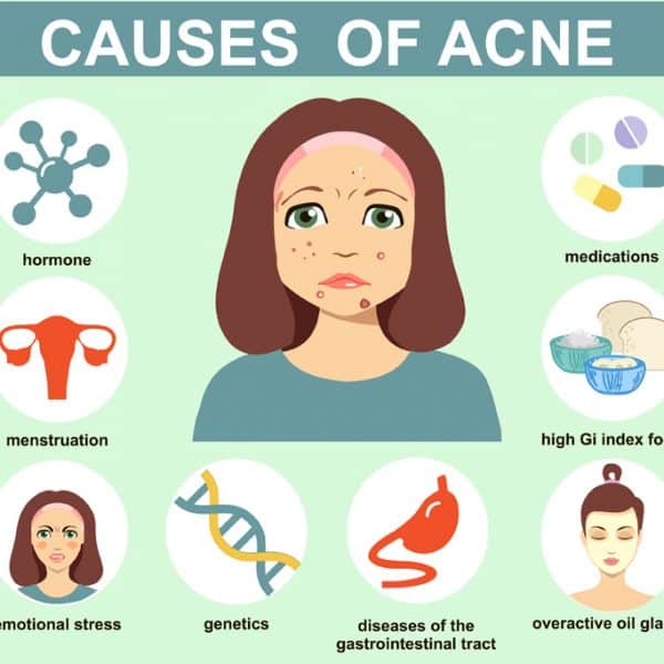 chart showing the causes of acne