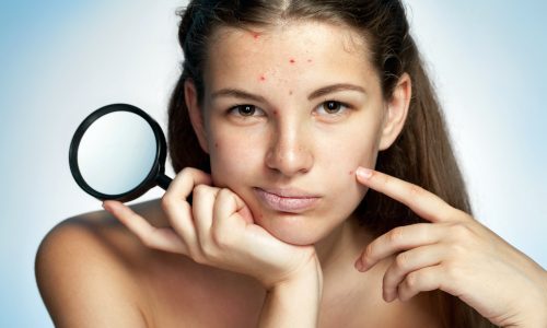Let’s Talk Skin: Acne and blackheads – causes, diagnosis and treatments
