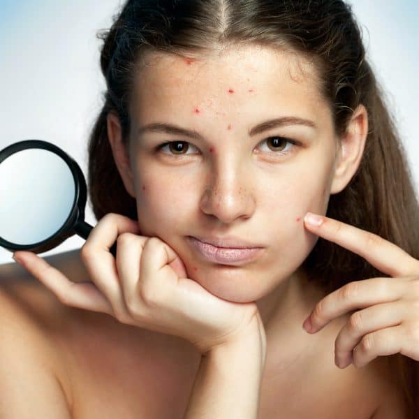 young woman with acne and blackheads