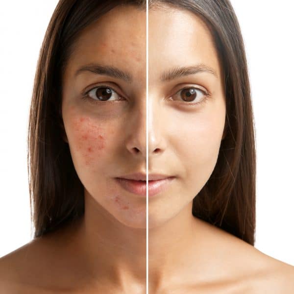 teenage girl with acne breakout shows results of acne treatment