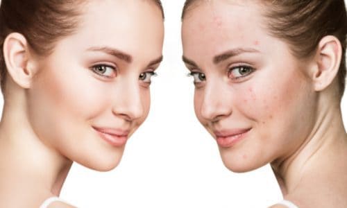 Let’s Talk Skin: How to combat PIMPLES and prevent against ACNE