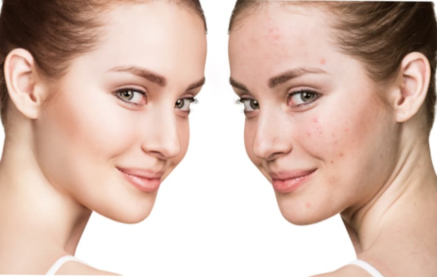 Let’s Talk Skin: How to combat PIMPLES and prevent against ACNE