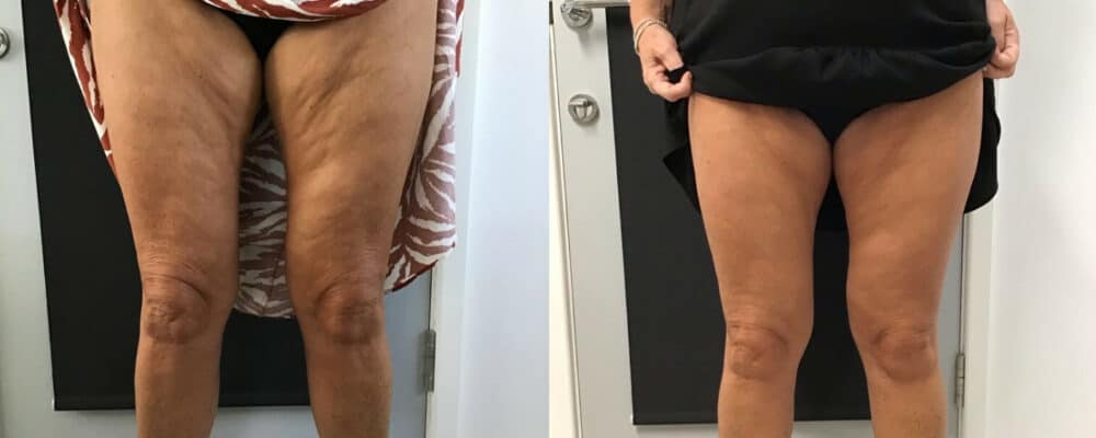 HIFU treatment results for inner thighs at Vie Aesthetics