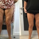 HIFU treatment results for inner thighs at Vie Aesthetics