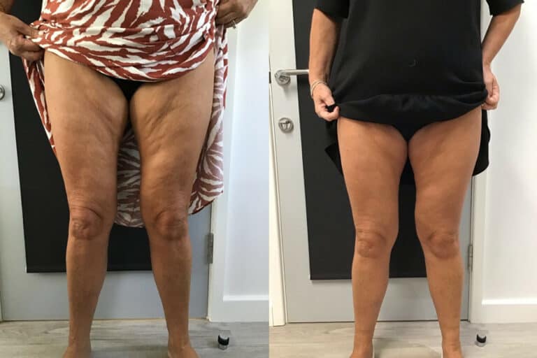 HIFU treatment results for inner thighs at Vie Aesthetics