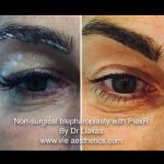 Younger looking eyes after PlexR treatment