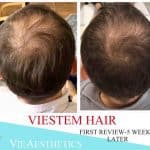 man shows off improved hair several months after VieStem Hair with Regenera Activa