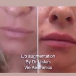 Before and after results of Princess Filler for lips treatment