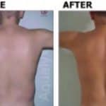 Upper body results from an Aqualyx fat dissolving injections for men