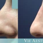 before and after procedure of non-surgical nose job at Vie Aesthetics