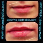 Before and after results of Princess Filler for lips treatment 2