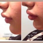 Female patient shows results of Princess Filler for lips treatment