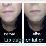 Princess Filler for lips treatment before and after photo