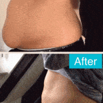 Before/after photo of excess tummy fat that is dissolved by Aqualyx