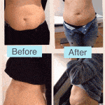 Results of Aqualyx anti-fat injections to remove fat around the abdomen