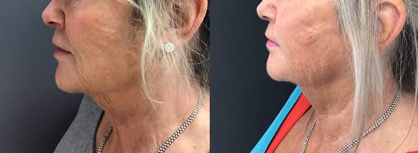 Middle-aged woman showing results of HIFU and Ellanse combination treatment for lower face area