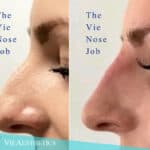 woman afer a non-surgical nose correction procedure at vie aesthetics