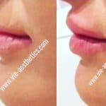 Woman showing results of Princess Filler for lips treatment