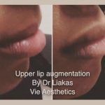 Before and after results of Princess Filler for lips treatment 3