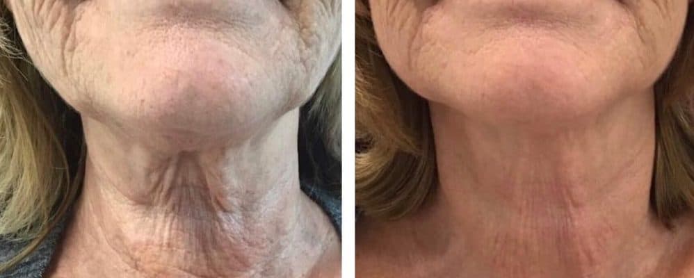 Combination treatment of HIFU for neck and Ellanse for lower-face areas.