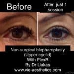 Before and after results of PlexR anti-ageing on droopy eyelids