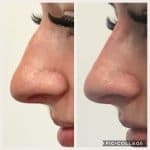 before and after results of a non-surgical nose job to correct an uneven nose