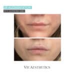a woman's lips after non-surgical lip filler treatment