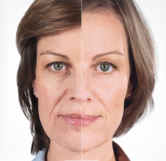 Sculptra® Liquid Facelift