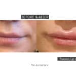 russian lip filler augmentation