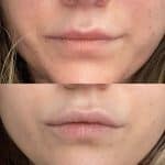 Juvederm smile filler for lips results at Vie Aesthetics