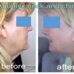 woman has aqualyx to eliminate double chin