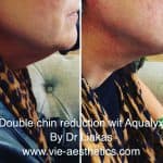 woman has her double chin reduced with aqualyx treatment