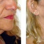 Woman in her 50s after HIFU treatment for jowls.