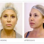 Woman showing before/after results of Silhouette Soft thread lift