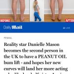 Endopeel treatment with Danielle Mason, performed by Dr Liakas, that appeared in the Daily Mail