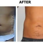 man showing toned tummy after aqualyx treatment