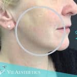 Woman after HIFU skin tightening treatment for jowls