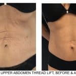 Upper abdomen non-surgical thread lift with Silhouette Soft at Vie Aesthetics, before and after