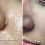 PlexR used to remove a mole on the face