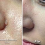 PlexR used to remove a mole on the face