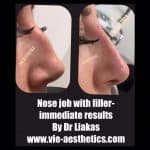 results of a non-surgical nose job with Dr Liakas