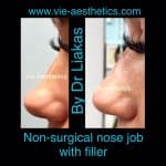 non-surgical nose job procedure with Dr Liakas