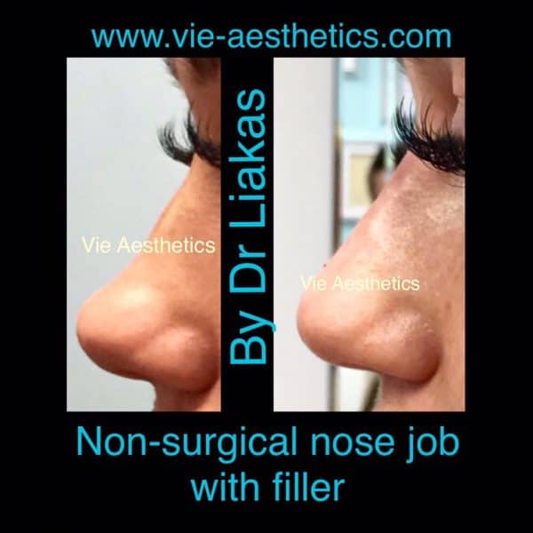 non-surgical nose job procedure with Dr Liakas