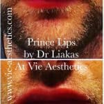 Man showing his before and after results of Princess Filler for lips