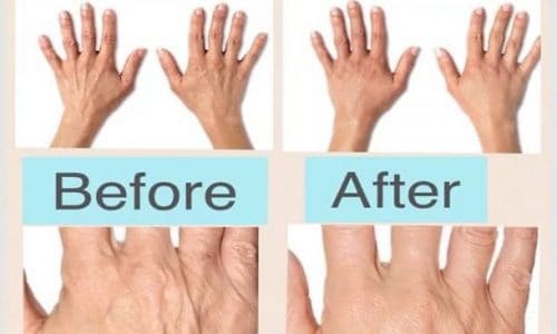 Taking care of those caring hands with Radiesse® volumising filler