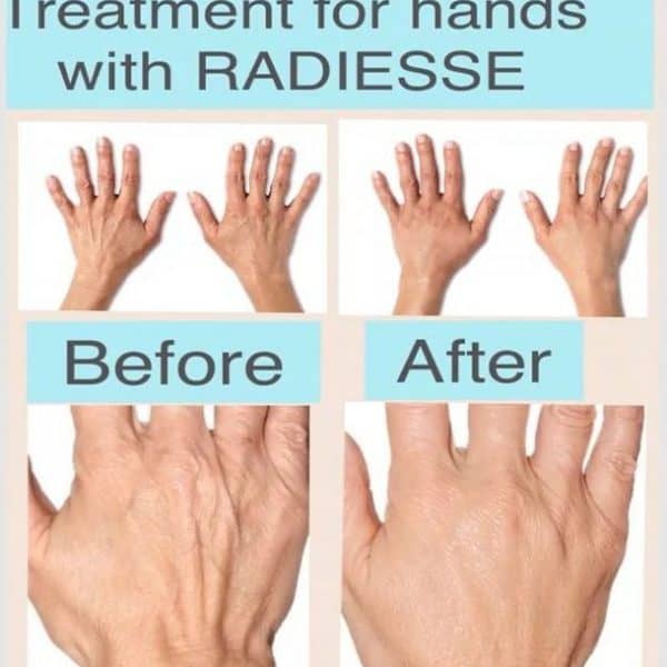 Restults of radiesse dermal filler treatment for ageing hands