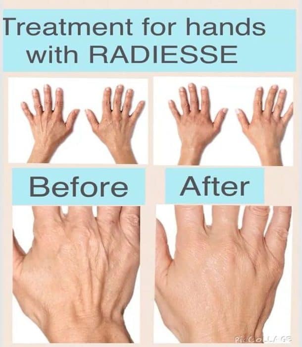 Taking care of those caring hands with Radiesse® volumising filler