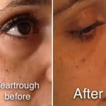 Woman with improved eye area after Tear trough treatment